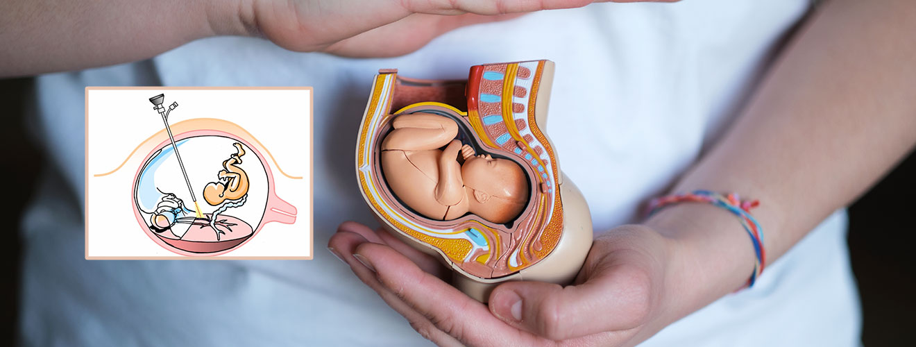 Fetal Reduction Procedure