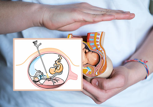 Fetal Reduction Procedure